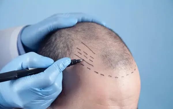 Exploring Hair Transplant Options: A Short Guide to Different Techniques